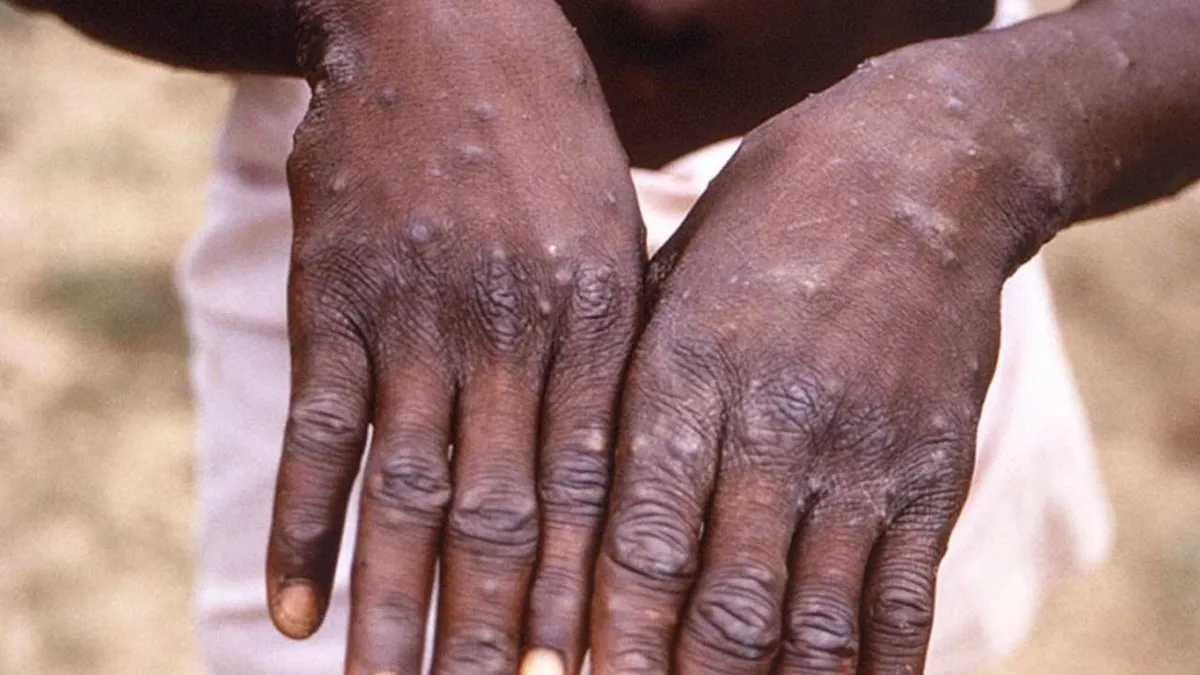 BM, Afrika’da giderek artan M çiçeği virüsünün kıta dışına yayılmasından endişeli