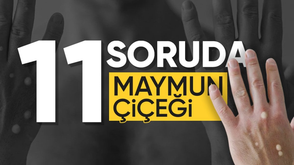 Sağlık Bakanlığı açıkladı: İşte 11 soruda maymun çiçeğiyle ilgili merak edilenler…